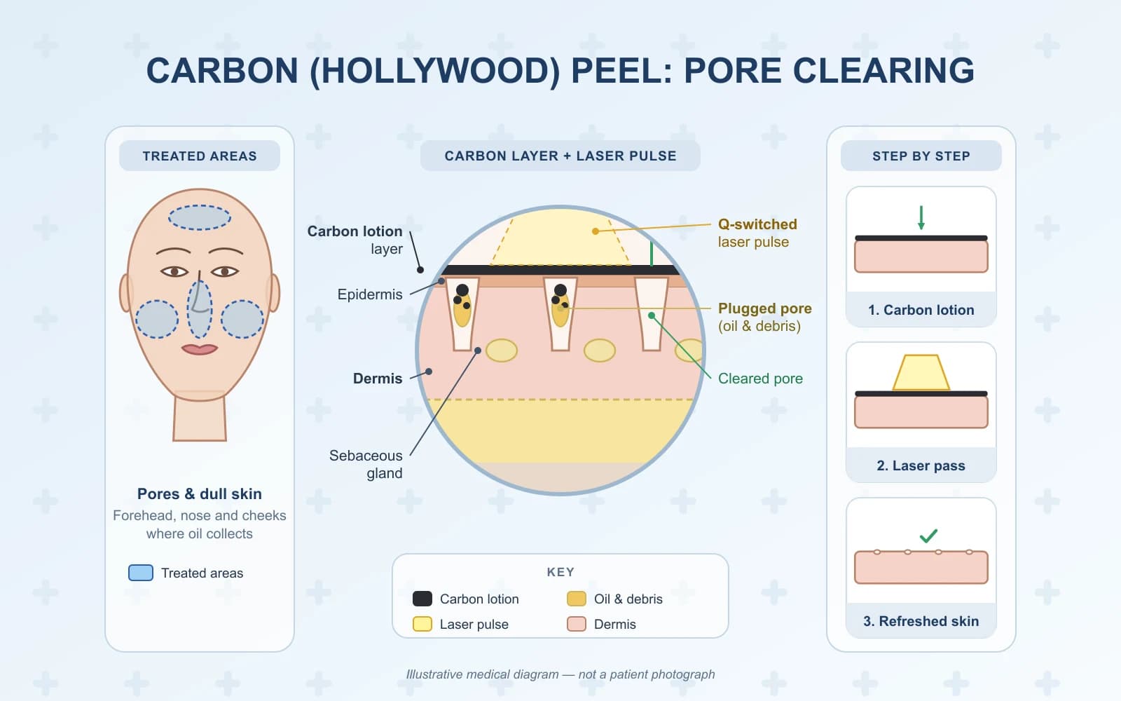 Carbon (Hollywood) Peel