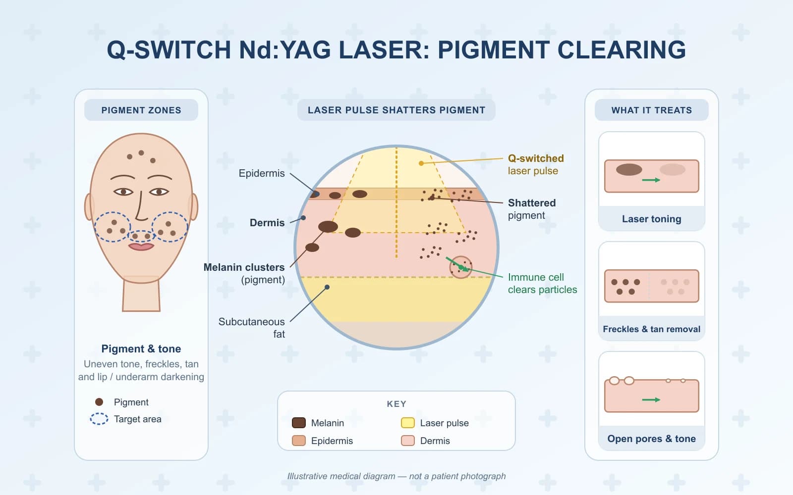 Q-Switch Laser Toning