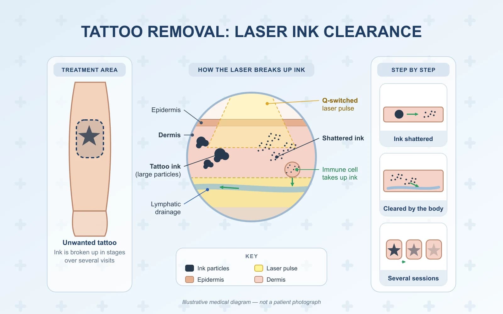 Tattoo Removal