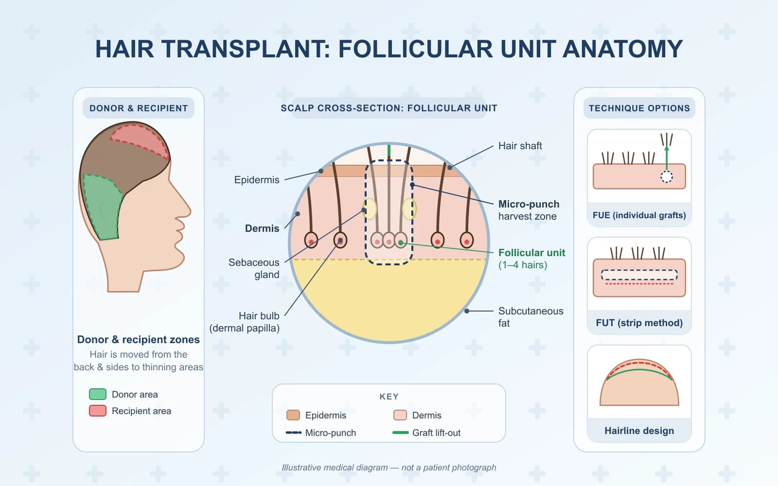 Hair Transplant (FUE)
