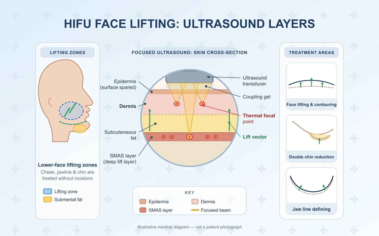 HIFU Face Lifting & Contouring (Doublo Gold)