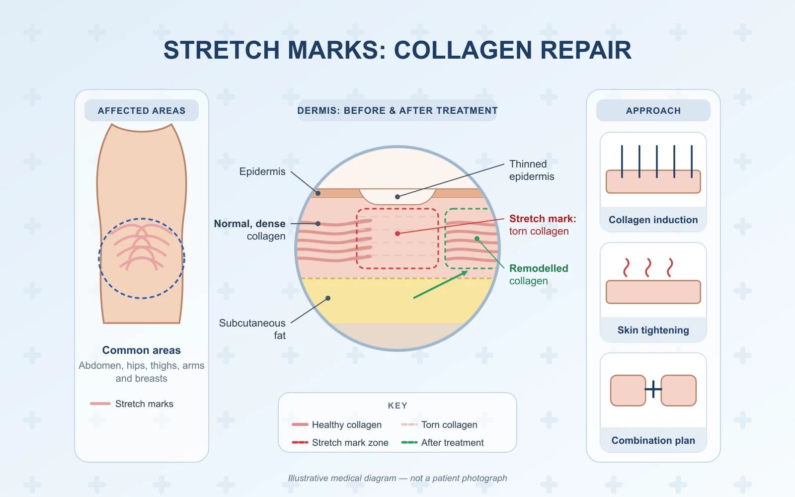Stretch Marks Treatment