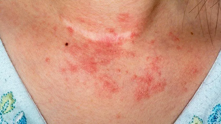 Atopic Dermatitis by dr ismat ara khan