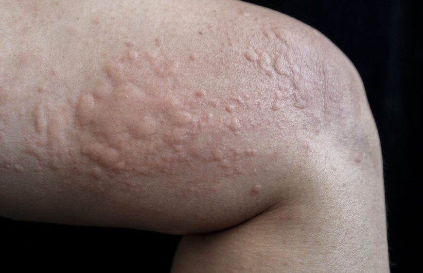 epi-urticaria-hives-scaled