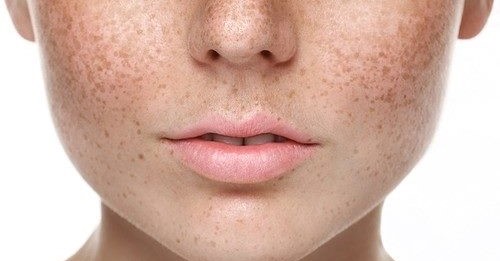 pigmentation-treatments by dr ismat ara khan
