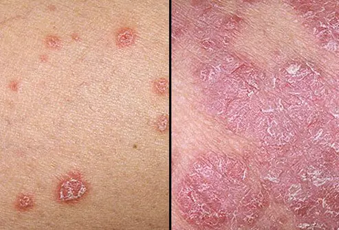psoriasis-symptoms dr ismat ara khan 1